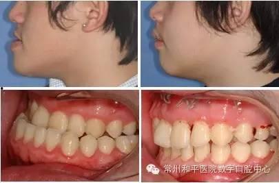 成人偏头可以矫正吗视频,揭秘矫正方法与效果